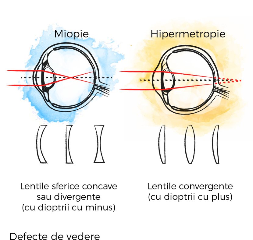 miopie hipermetropie