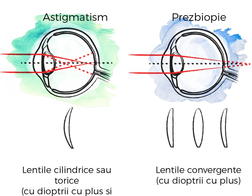 miopie sau ostigmatism)