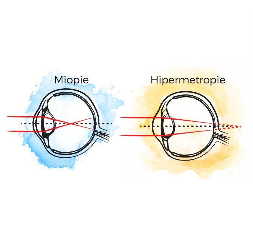 miopia apare hipermetropie